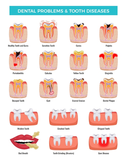 Free Vector dental oral problems educational infographic set with caries inflammation tooth plaque bad breath enamel erosion vector illustration