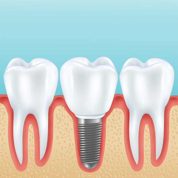 Dental prosthetics with healthy teeth