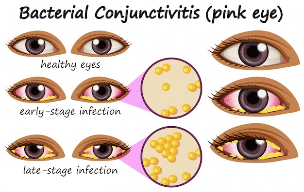 Free Vector diagram showing bacterial conjunctivitis in human eye