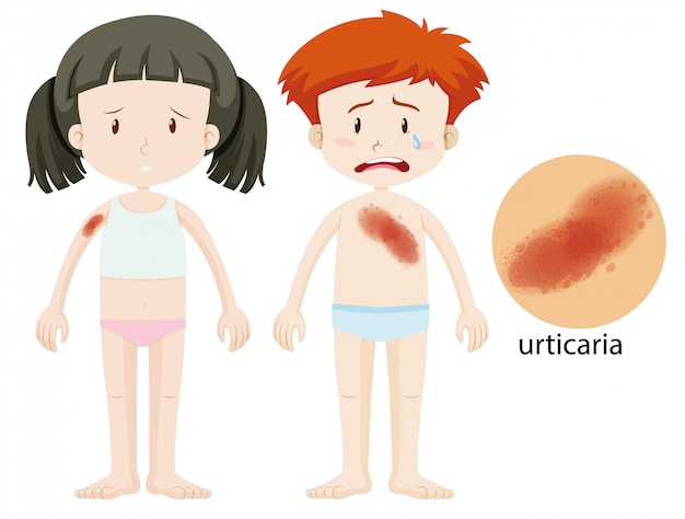 Free Vector diagram showing boy and girl with urticaria