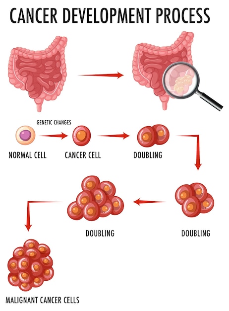 Free Vector diagram showing cancer development process