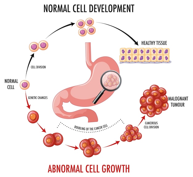 Diagram showing cancer in stomach