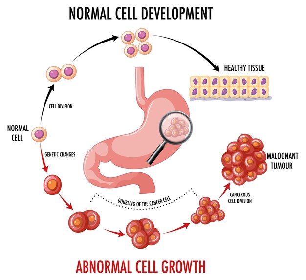 Diagram showing cancer in stomach