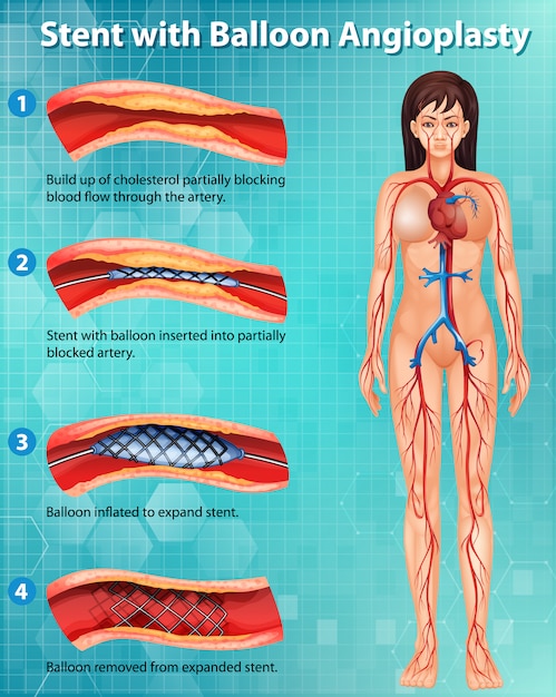 Free vector diagram showing cholesterol blocking artery in human body