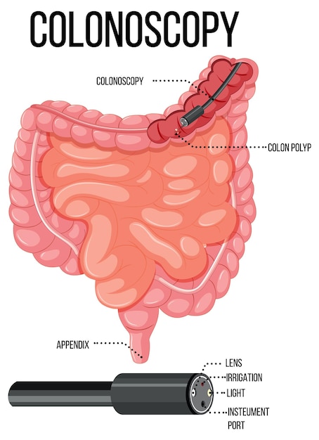 Diagram showing colonoscopy in human