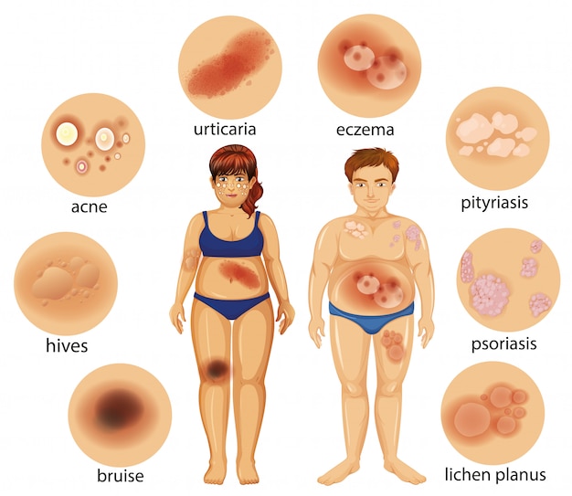 Free Vector diagram showing different skin diseases