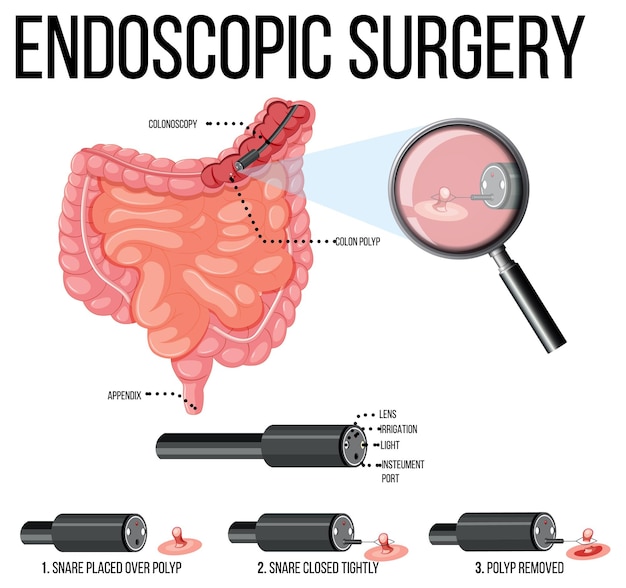 Free Vector diagram showing endoscopic surgery