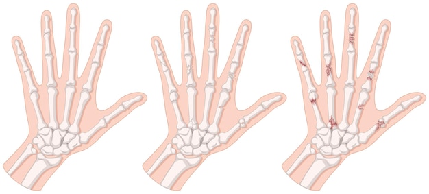 Diagram showing hand fracture