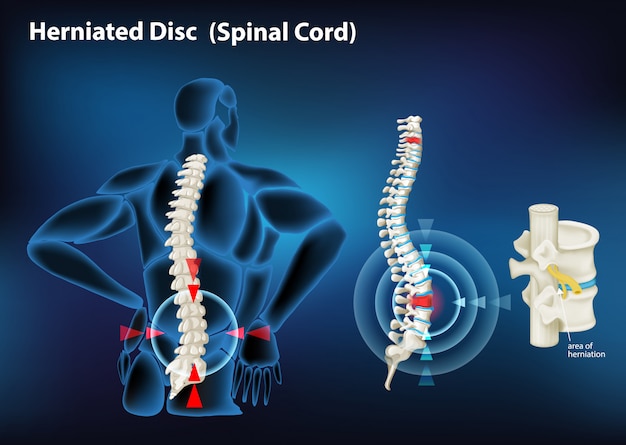 Free Vector diagram showing herniated disc in human