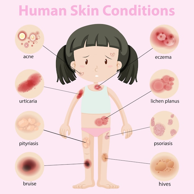 Free Vector diagram showing human skin conditions