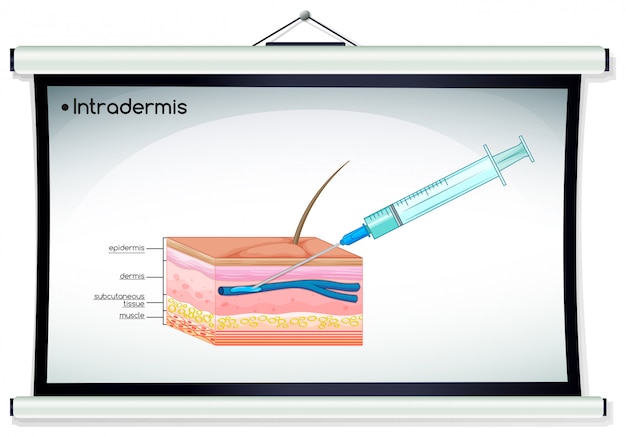 Free Vector diagram showing intradermis injection