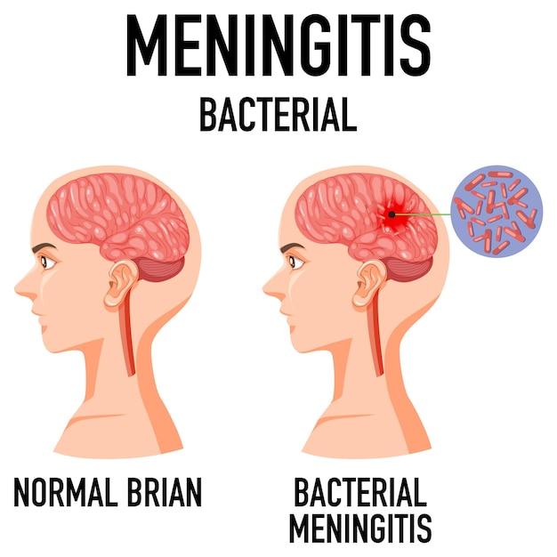 Diagram showing meningitis bacterial in brain