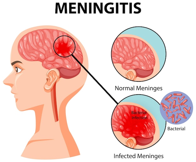 Diagram showing meningitis in human brain