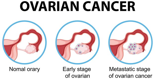 Diagram showing ovarina cancer in human