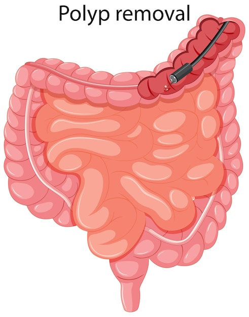 Diagram showing polyp removal