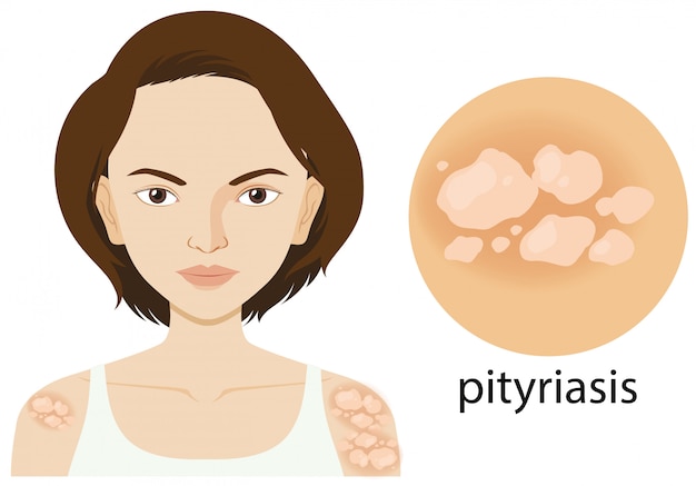 Diagram showing woman with pityriasis