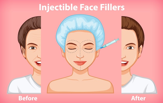 Free Vector different of face fillers before and after