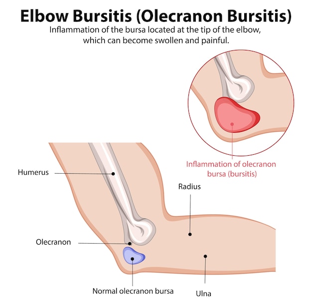 Elbow Bursitis Medical Illustration