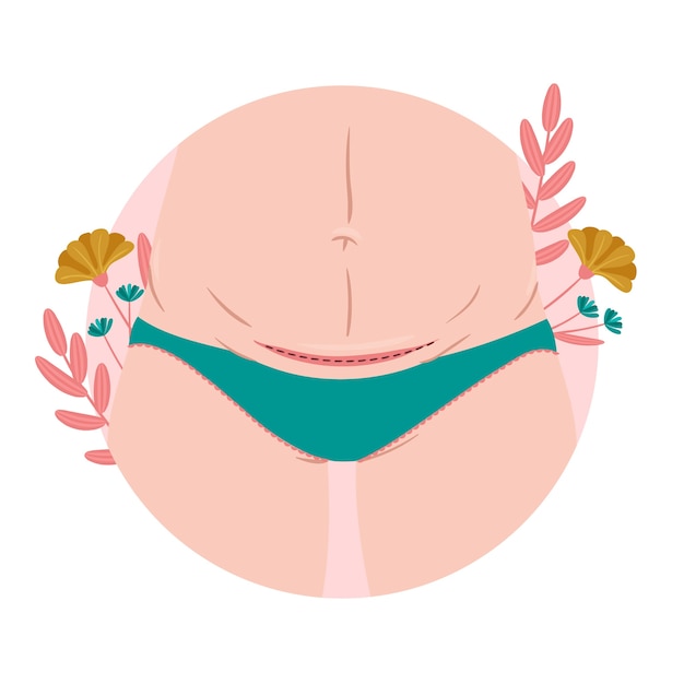 Flat design cesarean section incision