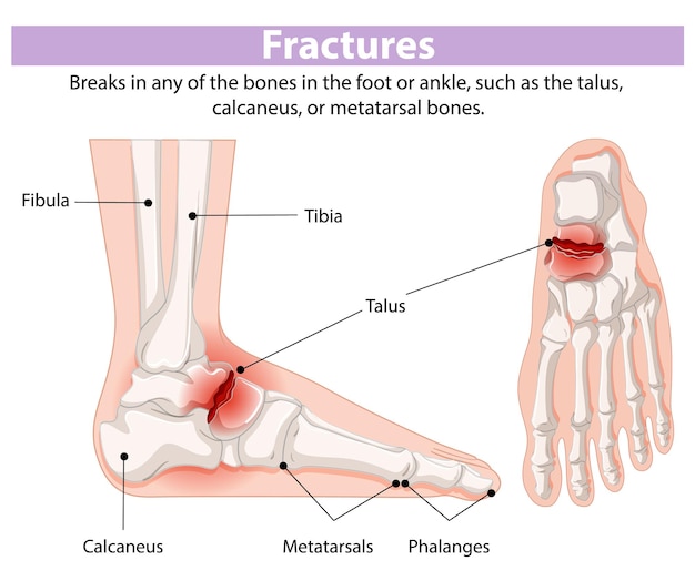 Foot and Ankle Fracture Diagram