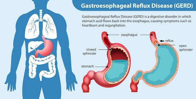 Free vector gastroesophageal reflux disease gerd diagram