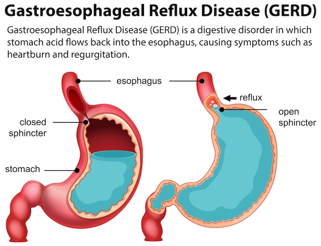 Free Vector gastroesophageal reflux disease gerd diagram