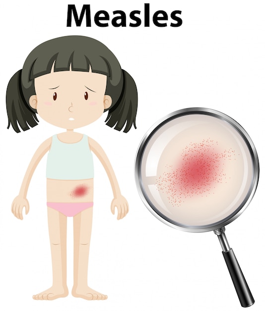 Free Vector a girl having measles