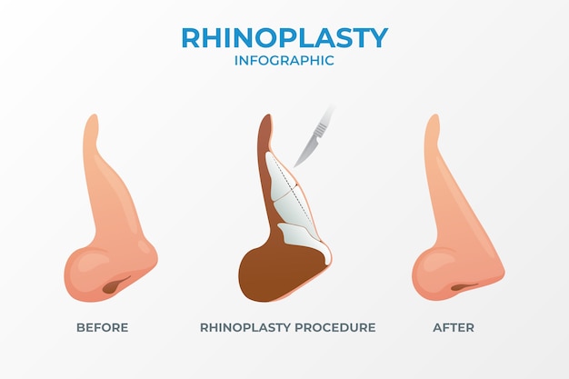 Gradient rhinoplasty infographic