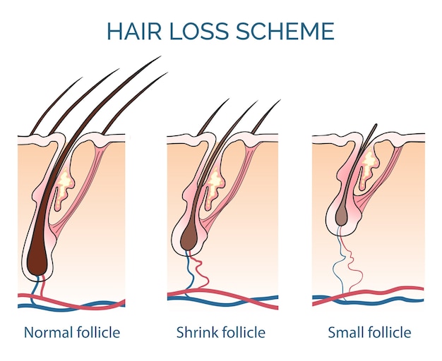 Free Vector hair loss scheme. loss hair, growth hair problem, health hair. vector illustration