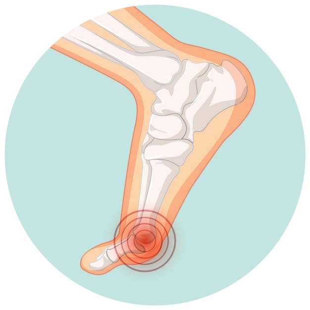 Free vector hallux valgus types in circle template