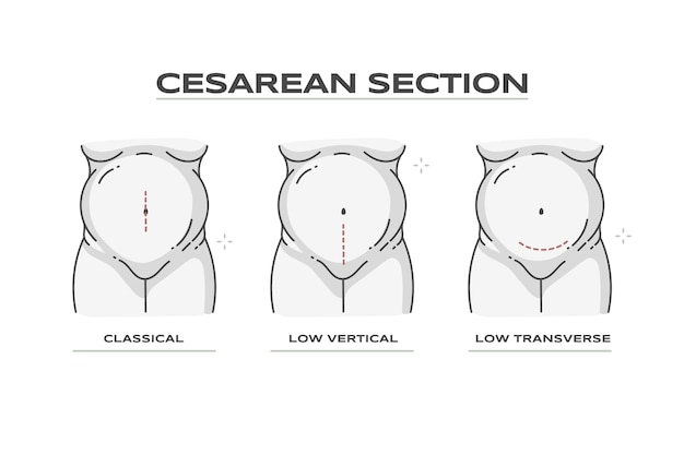 Hand drawn flat design cesarean section