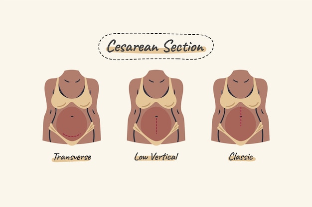 Hand drawn flat design cesarean section