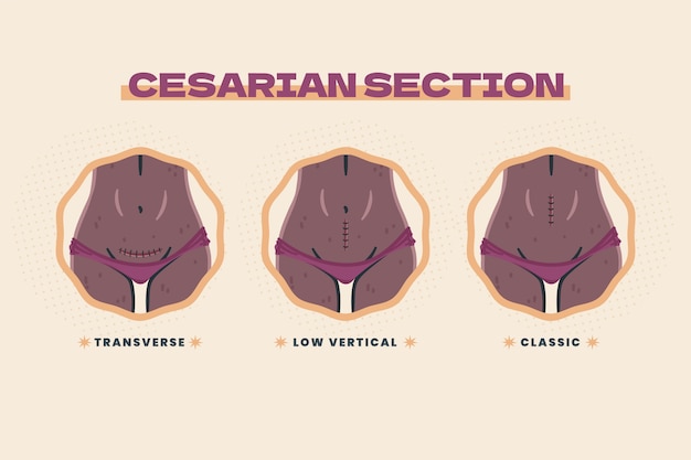 Hand drawn flat design cesarean section