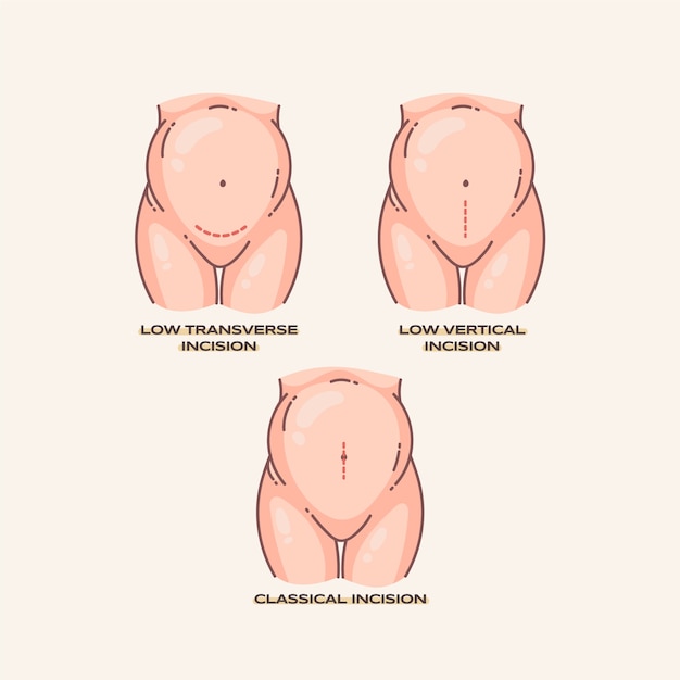 Hand drawn flat design cesarean section