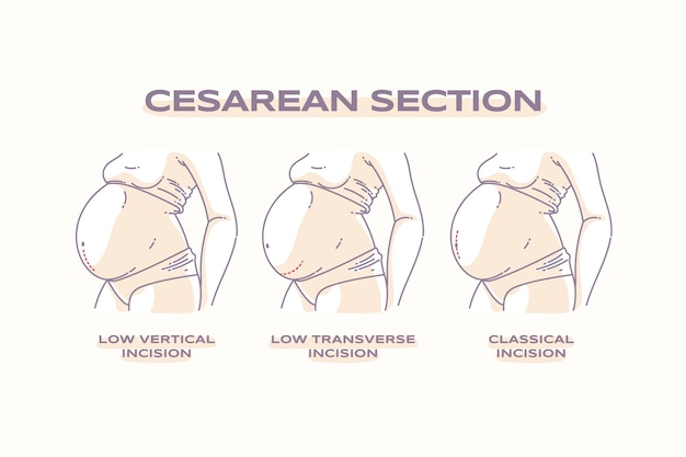 Hand drawn flat design cesarean section