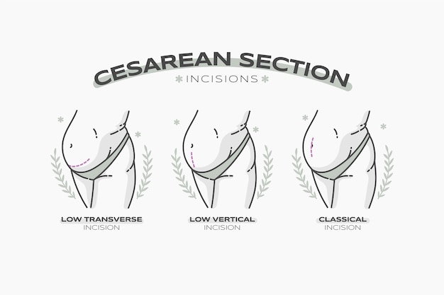 Hand drawn flat design cesarean section