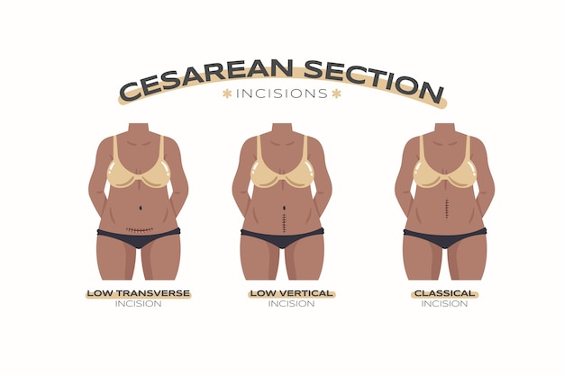 Hand drawn flat design cesarean section