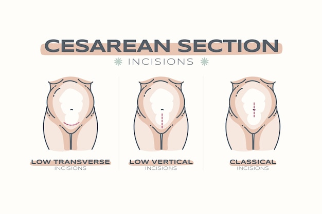 Hand drawn flat design cesarean section