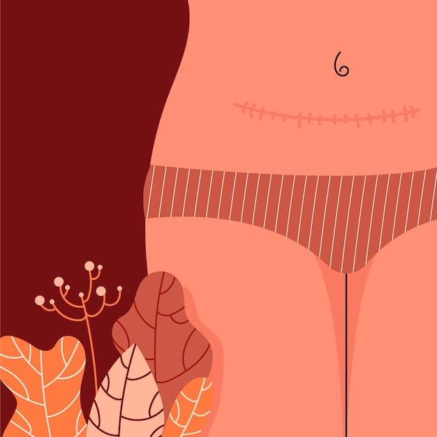 Hand drawn flat design cesarean section