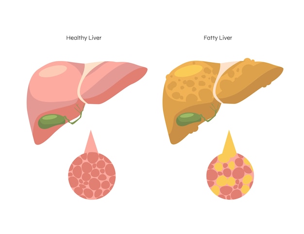 Hand drawn flat design fatty liver illustration