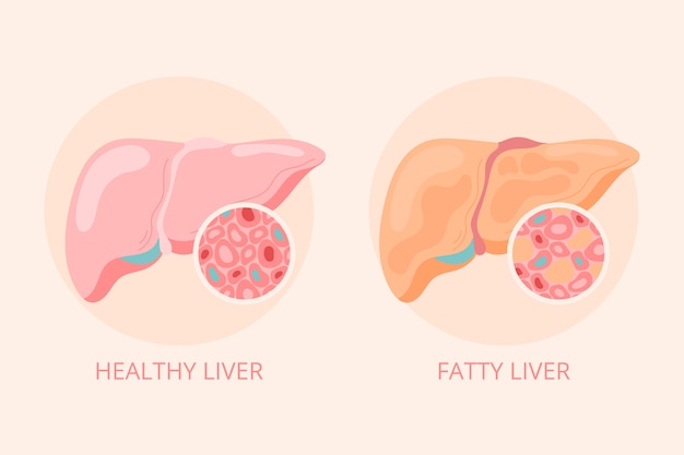 Hand drawn flat design fatty liver illustration