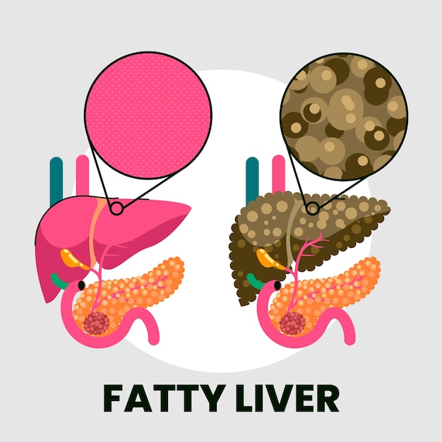 Hand drawn flat design fatty liver illustration