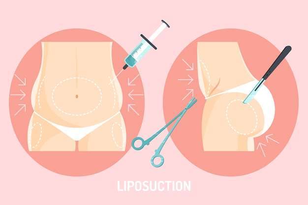 Hand drawn flat design liposuction illustration