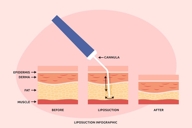 Hand drawn flat design liposuction infographic