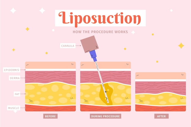 Free vector hand drawn flat design liposuction infographic