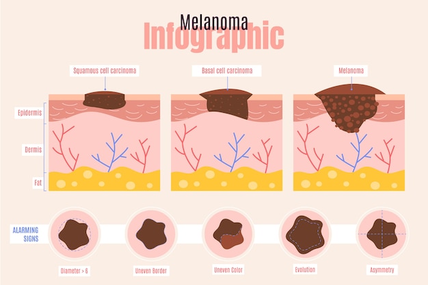 Free Vector hand drawn flat design melanoma infographic