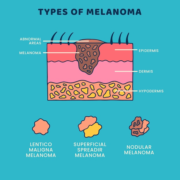 Free Vector hand drawn flat design melanoma infographic