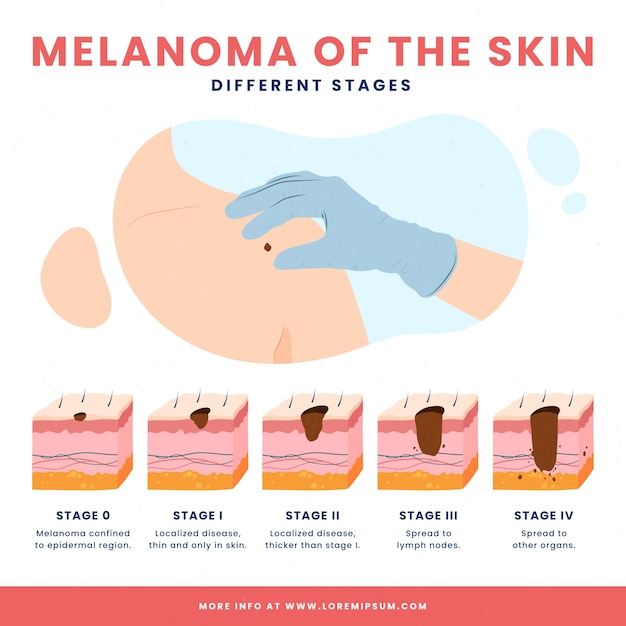 Hand drawn flat design melanoma infographic