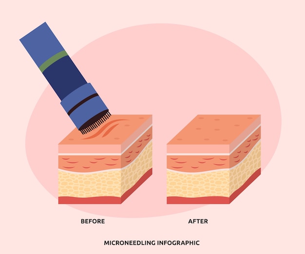 Free Vector hand drawn flat design micro needling infographic