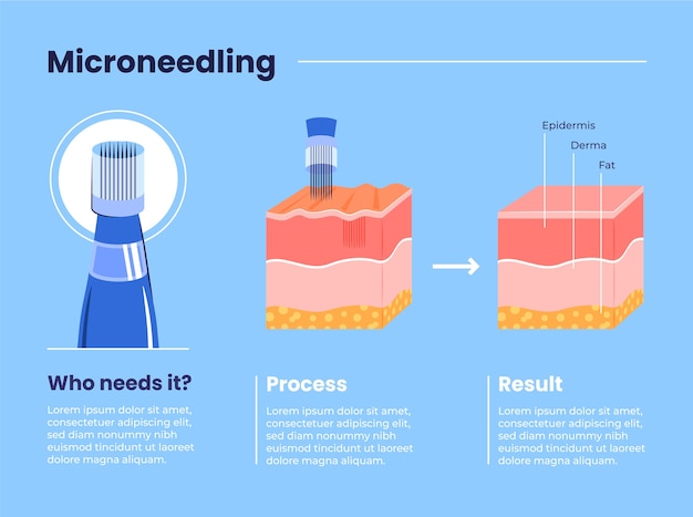 Hand drawn flat design micro needling infographic